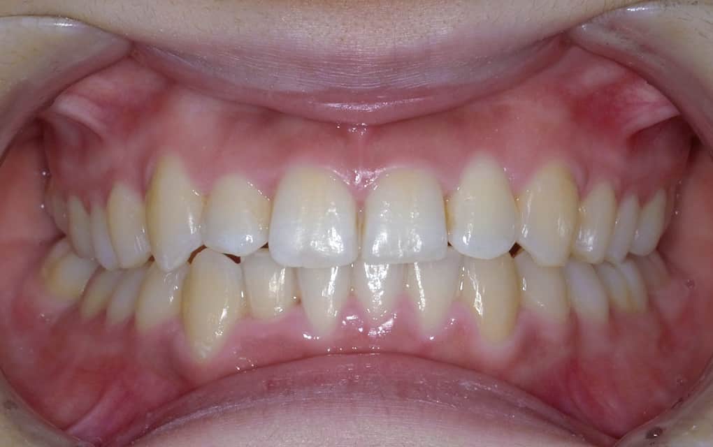 治療イメージ1 矯正後の口の写真