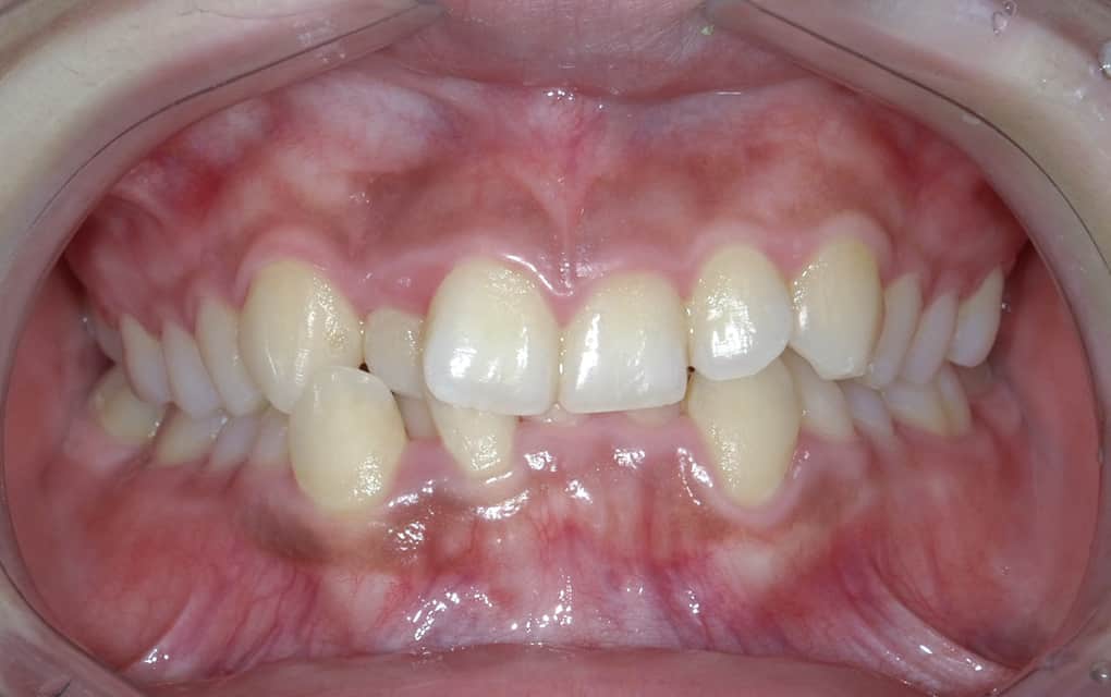 治療イメージ1 矯正前の口の写真