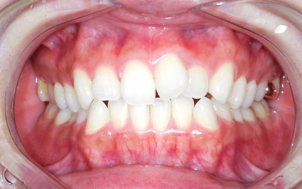 治療イメージ2 矯正前の口の写真